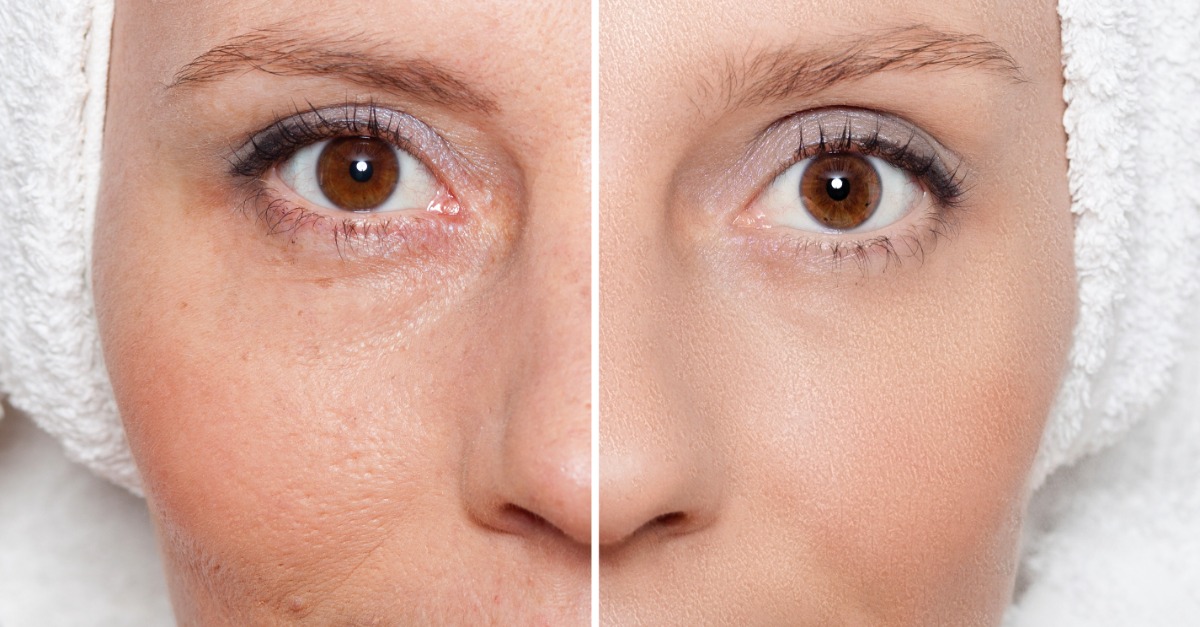 Medical Spa Treatment Reducing Signs Of Aging Being Shown on Instagram Posts
